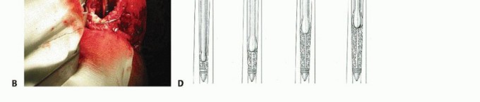 Illustration 18 for Exeter Hip Unit: Mastering Impaction Allografting for Femoral Bone Loss