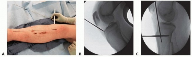 Illustration 24 for Optimizing Intramedullary Nailing for Tibial Shaft Fractures