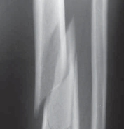 Illustration 12 for Optimizing ORIF for Tibial Plafond Fractures: A Modern Approach