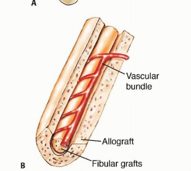 Illustration 34 for Free Vascularized Fibular Grafts: Solving Complex Bone Defects