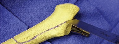 Illustration 16 for Achieving Success with Trochanteric Osteotomy Posterior for Revision