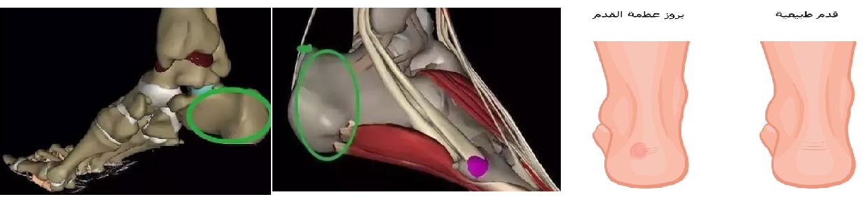 بروز عظمه العقب: وداعًا للألم! دليل شامل للأسباب والعلاج.