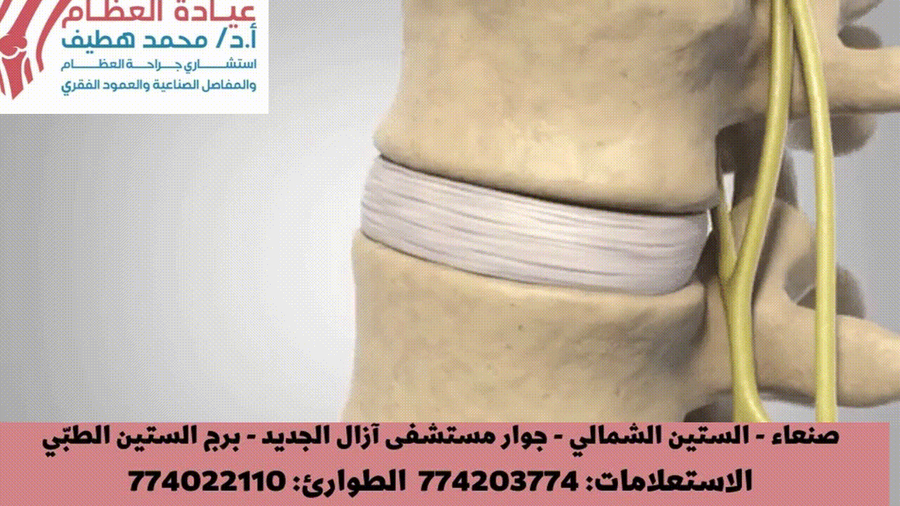 الانزلاق الغضروفي بالصور: علاماته، أسبابه، ومتى يجب استشارة الطبيب