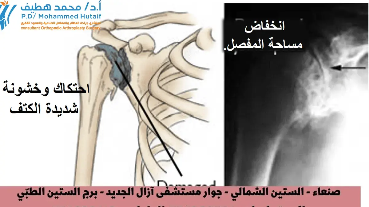 العضلة ذات الرأسين: دليلك الشامل لآلام المرفق وعلاجها الفعال
