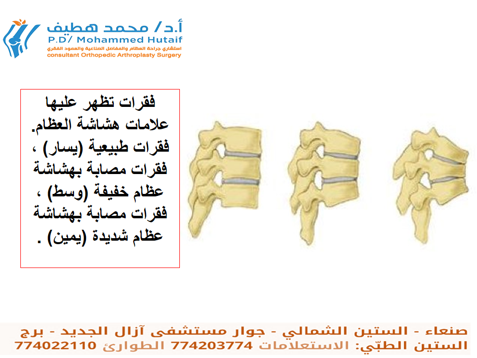 هشاشة العظام-دكتور عظام