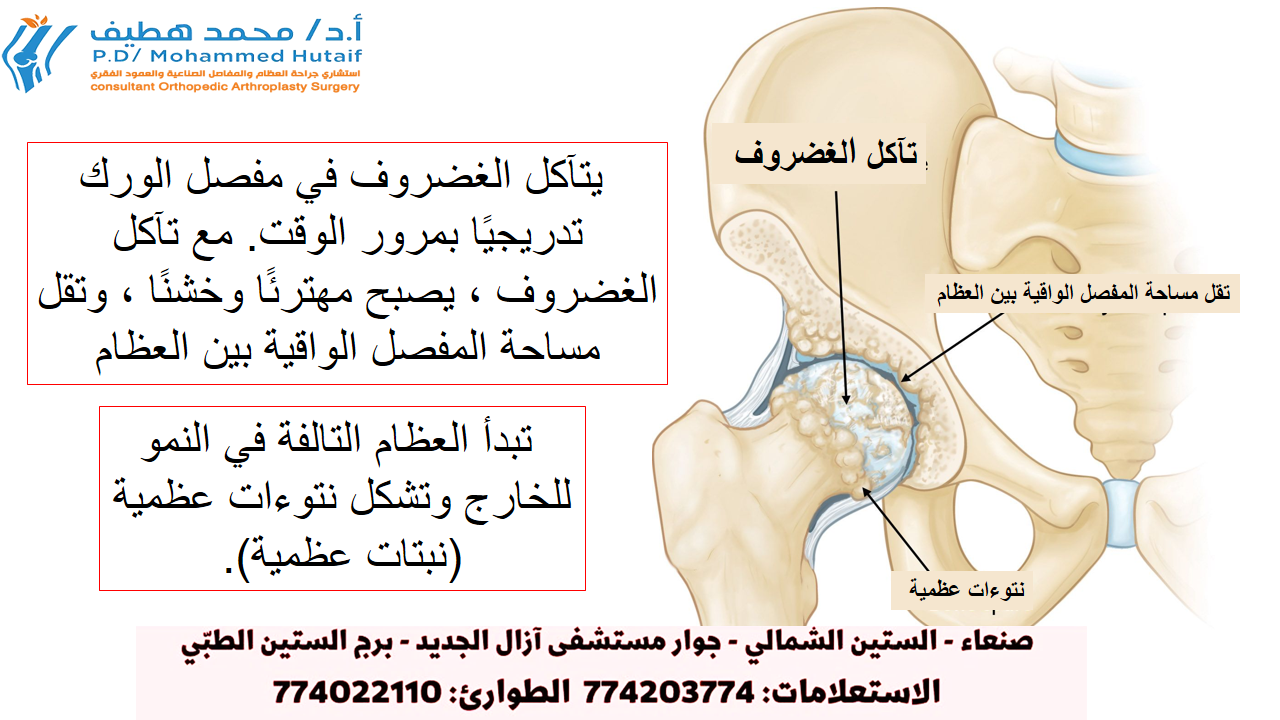 عملية استبدال مفصل الحوض