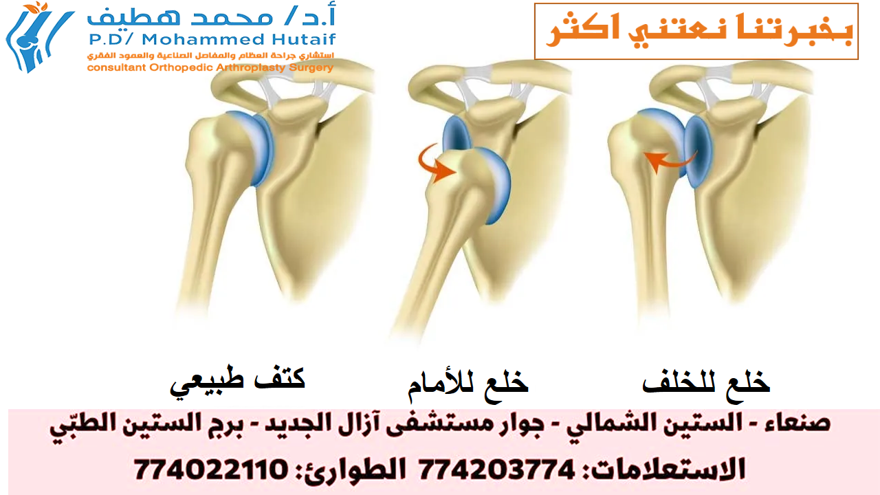 أعراض خلع الكتف