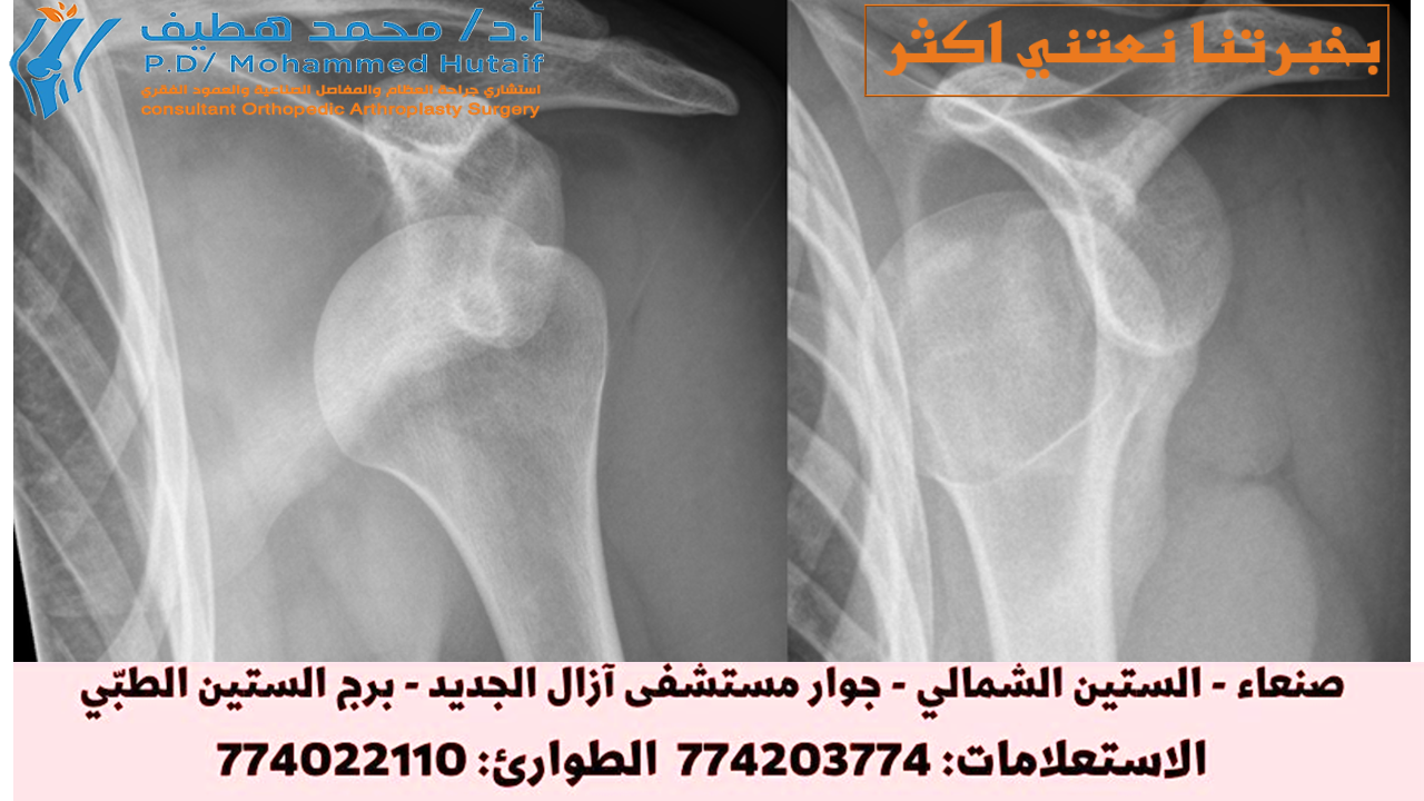 خلع الكتف: الفحص الطبي وأهم الأسئلة لطبيبك
