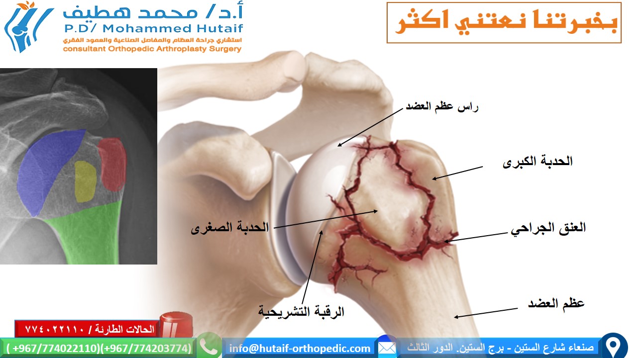 Fractures of the Humerus: Causes, Symptoms, Treatment & Recovery