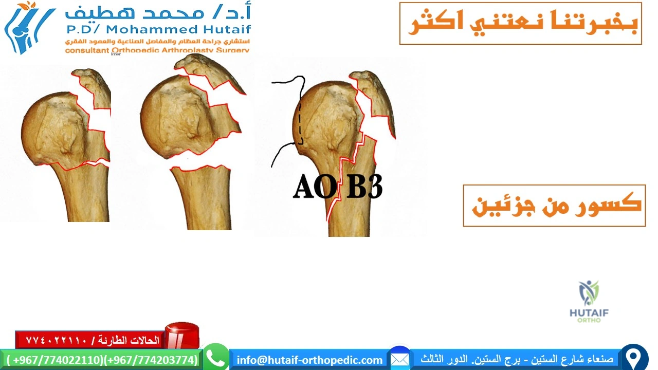 An X-ray of a proximal humerus fracture