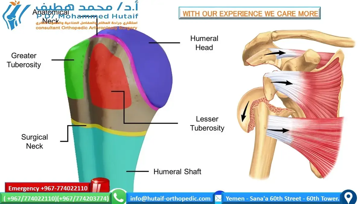 كسور الحدبة الكبرى في الكتف: الدليل الشامل للمرضى مع الأستاذ الدكتور محمد هطيف
