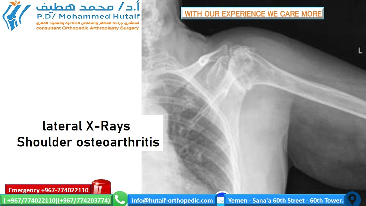 Shoulder Osteoarthritis Doctor Examination: Key Insights Revealed