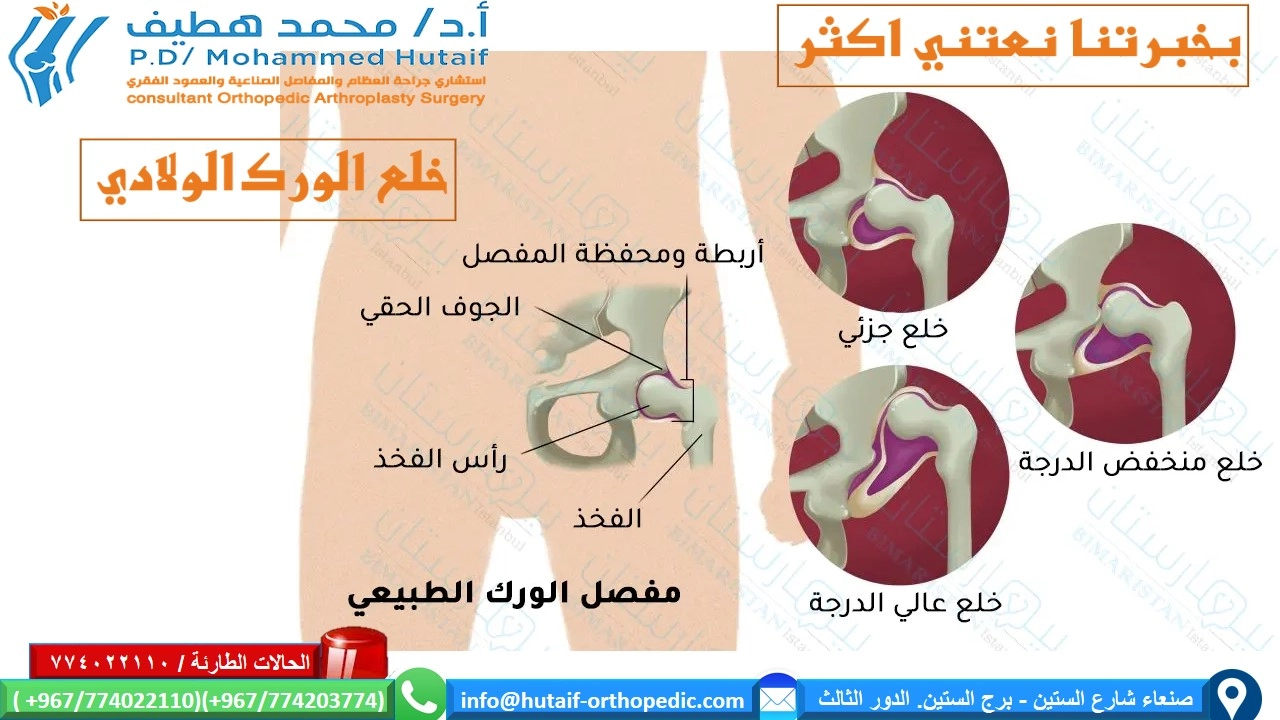درجات خلع الورك
