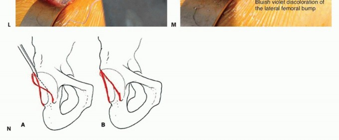 Illustration 37 for Anterior FAI Relief: Mini-Open Anterior Approach Explained
