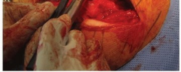 Illustration 14 for Extended Trochanteric Osteotomy: How et al Extended Revision THA Solutions