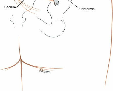 Illustration 11 for Simple & Safe Posterior Approach to the Sacroiliac: Key Techniques