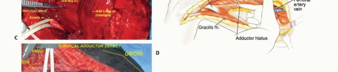 Illustration 9 for Optimizing Adductor Muscle Group Resection for Limb Preservation