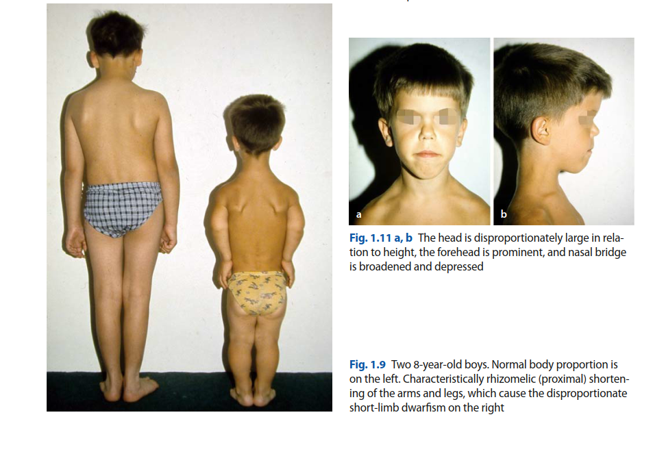 Illustration 2 for Orthopedic Cases Achondroplasia: Essential Insights & Management