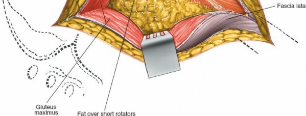 Illustration 179 for Unlocking Every Aspect of the Hip's Surgical Approaches