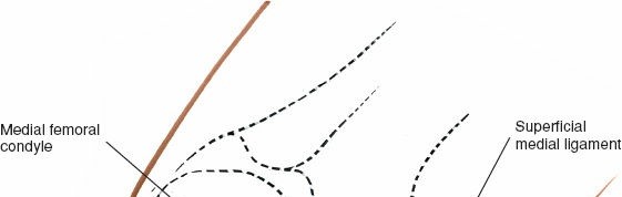 Illustration 58 for Mastering Knee Approaches: Spotlight on Superficial Medial Ligament