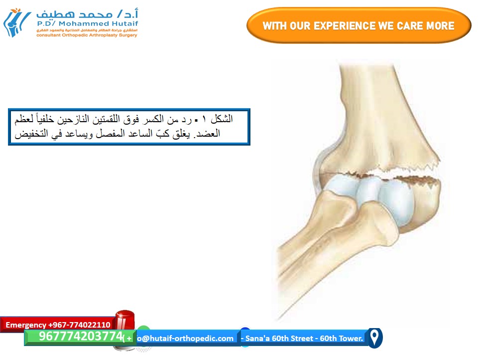 الرد المغلق والتثبيت عن طريق الجلد لكسور فوق اللقمتين في عظم العضد