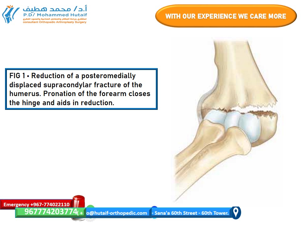 FIG 1 • Reduction of a posteromedially displaced supracondylar fracture of the humerus. Pronation of the forearm closes the hinge and aids in reduction.