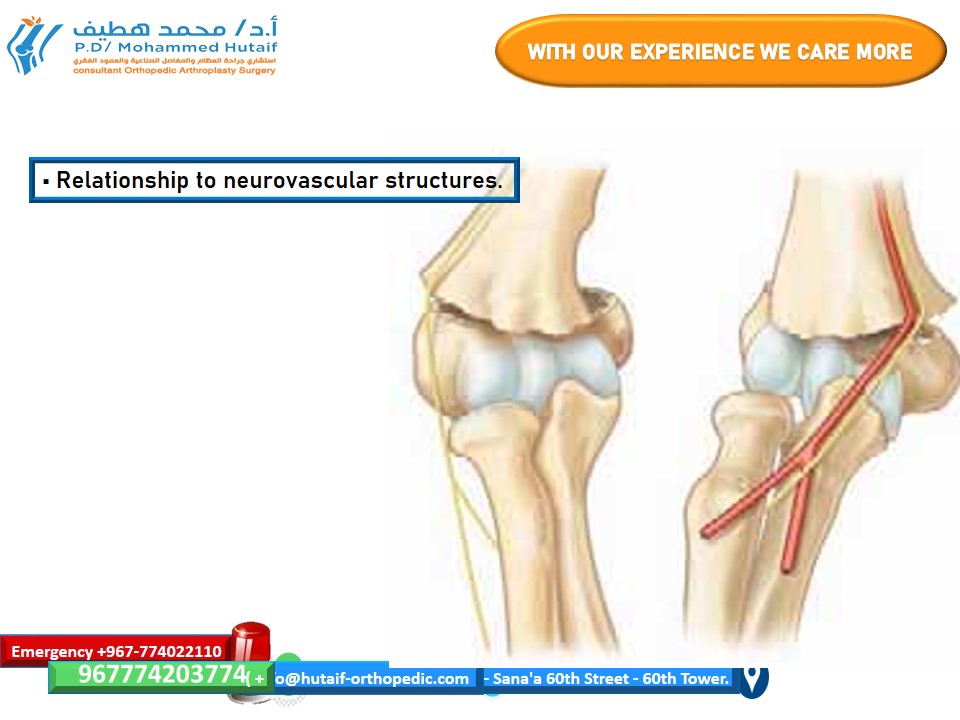 Image showing lateral K-wire placement for a supracondylar fracture of the humerus.