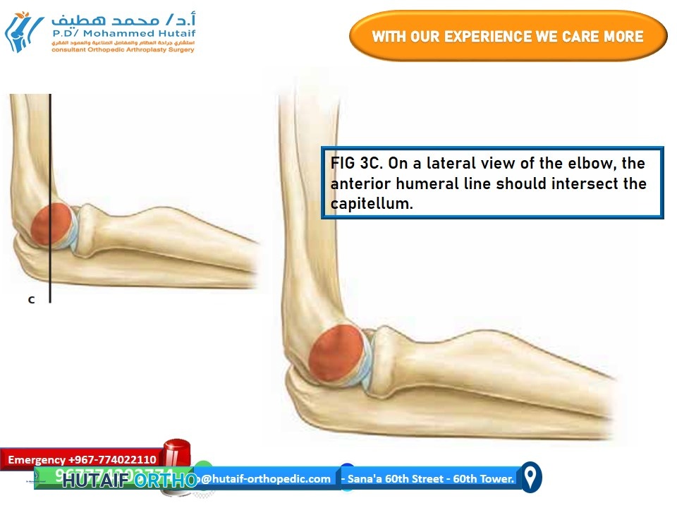 Image showing a lateral C-arm view of a supracondylar fracture, likely pre-reduction.