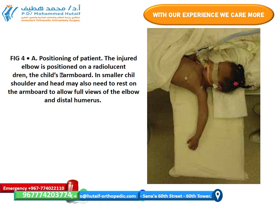 Illustration of nonoperative management supracondylar - Dr. Mohammed Hutaif