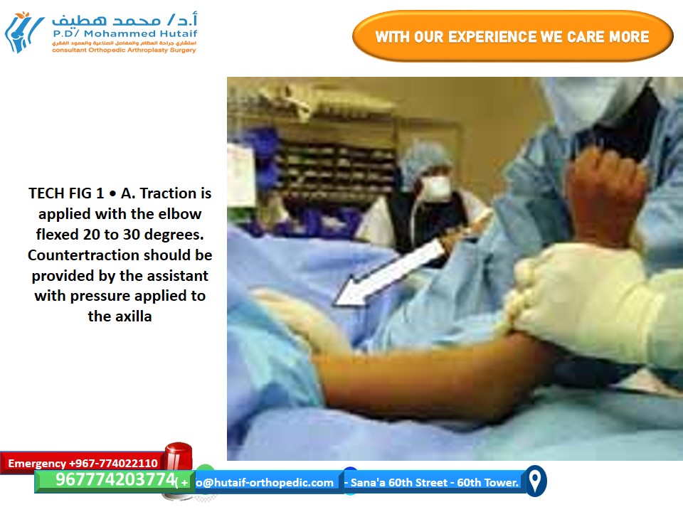 Illustration of closed reduction supracondylar - Dr. Mohammed Hutaif