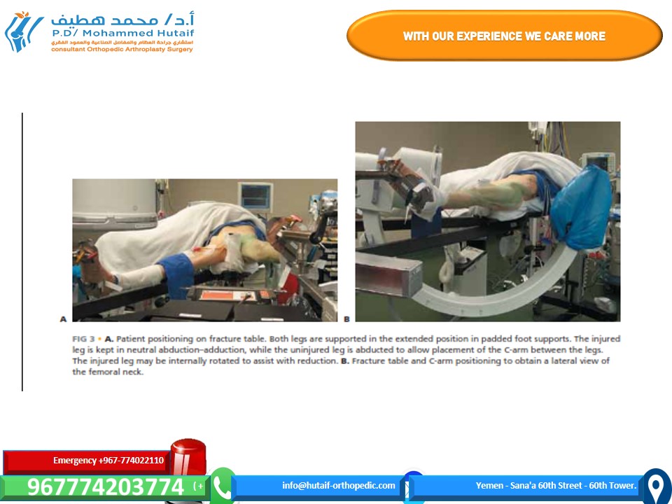Illustration 3 for Mastering Femoral Neck Fractures: How the Patient Is Positioned