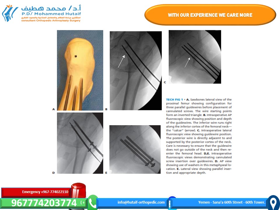 Illustration 4 for Mastering Femoral Neck Fractures: How the Patient Is Positioned