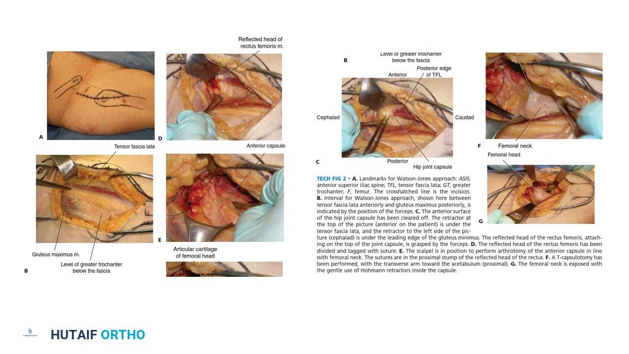Illustration 5 for Mastering Femoral Neck Fractures: How the Patient Is Positioned