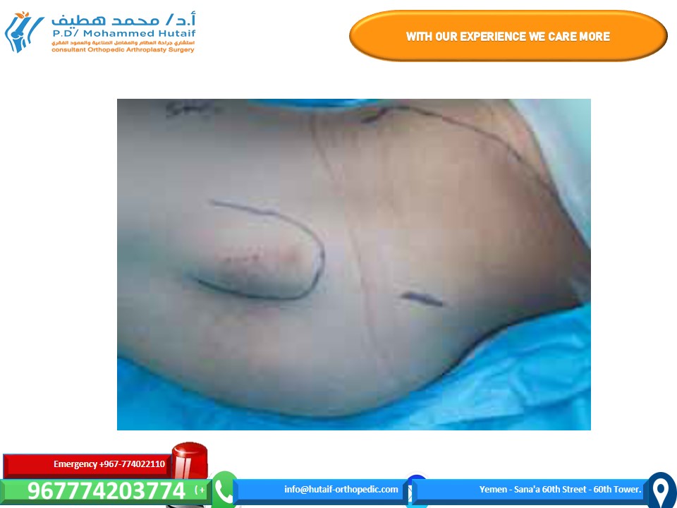Illustration 6 for Mastering Femoral Neck Fractures: How the Patient Is Positioned