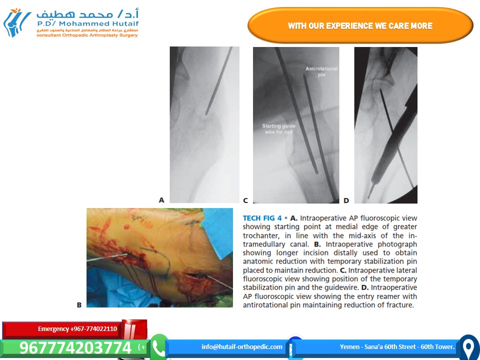 Illustration 7 for Mastering Femoral Neck Fractures: How the Patient Is Positioned