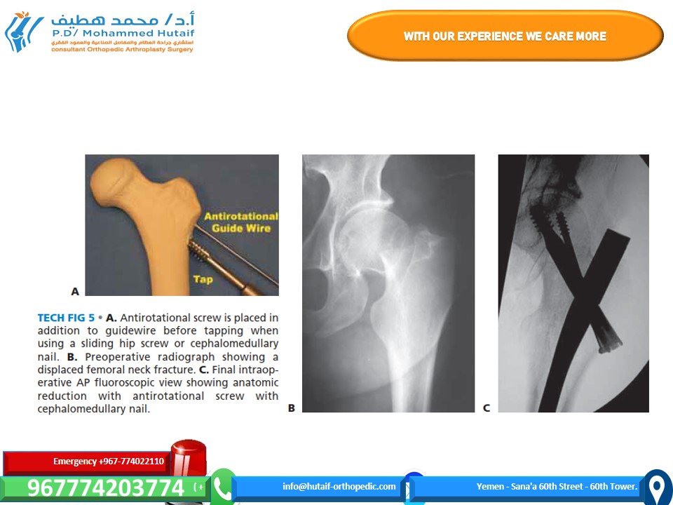 Illustration 8 for Mastering Femoral Neck Fractures: How the Patient Is Positioned
