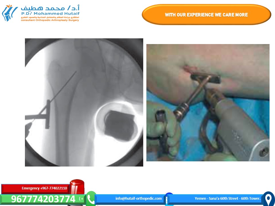 Illustration 9 for Mastering Femoral Neck Fractures: How the Patient Is Positioned