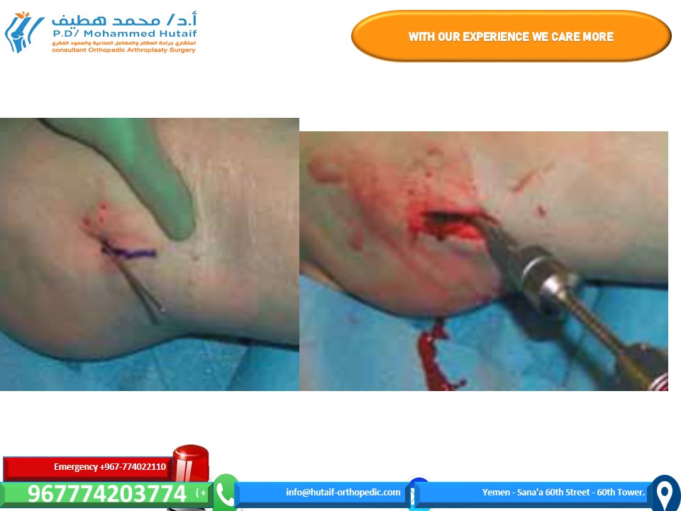 Illustration 10 for Mastering Femoral Neck Fractures: How the Patient Is Positioned