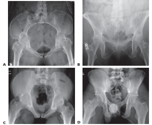 Illustration 2 for Symphysis Pubic Symphysis: Mastering ORIF for Disruption