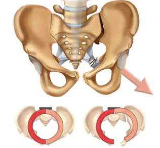 Illustration 3 for Symphysis Pubic Symphysis: Mastering ORIF for Disruption