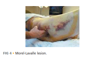 Illustration 4 for Symphysis Pubic Symphysis: Mastering ORIF for Disruption