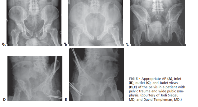 Illustration 5 for Symphysis Pubic Symphysis: Mastering ORIF for Disruption