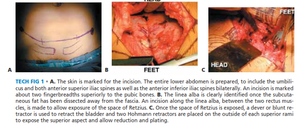 Illustration 6 for Symphysis Pubic Symphysis: Mastering ORIF for Disruption