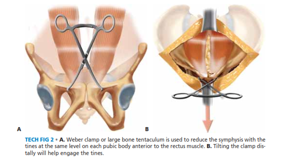 Illustration 7 for Symphysis Pubic Symphysis: Mastering ORIF for Disruption