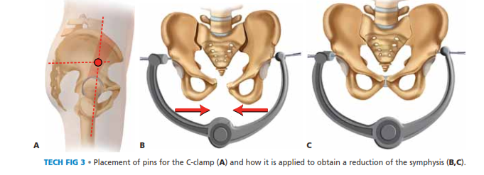 Illustration 8 for Symphysis Pubic Symphysis: Mastering ORIF for Disruption