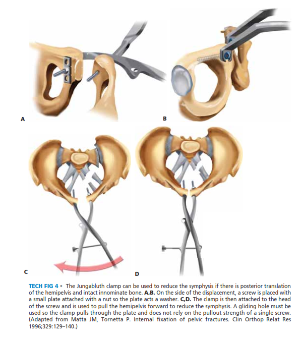 Illustration 9 for Symphysis Pubic Symphysis: Mastering ORIF for Disruption