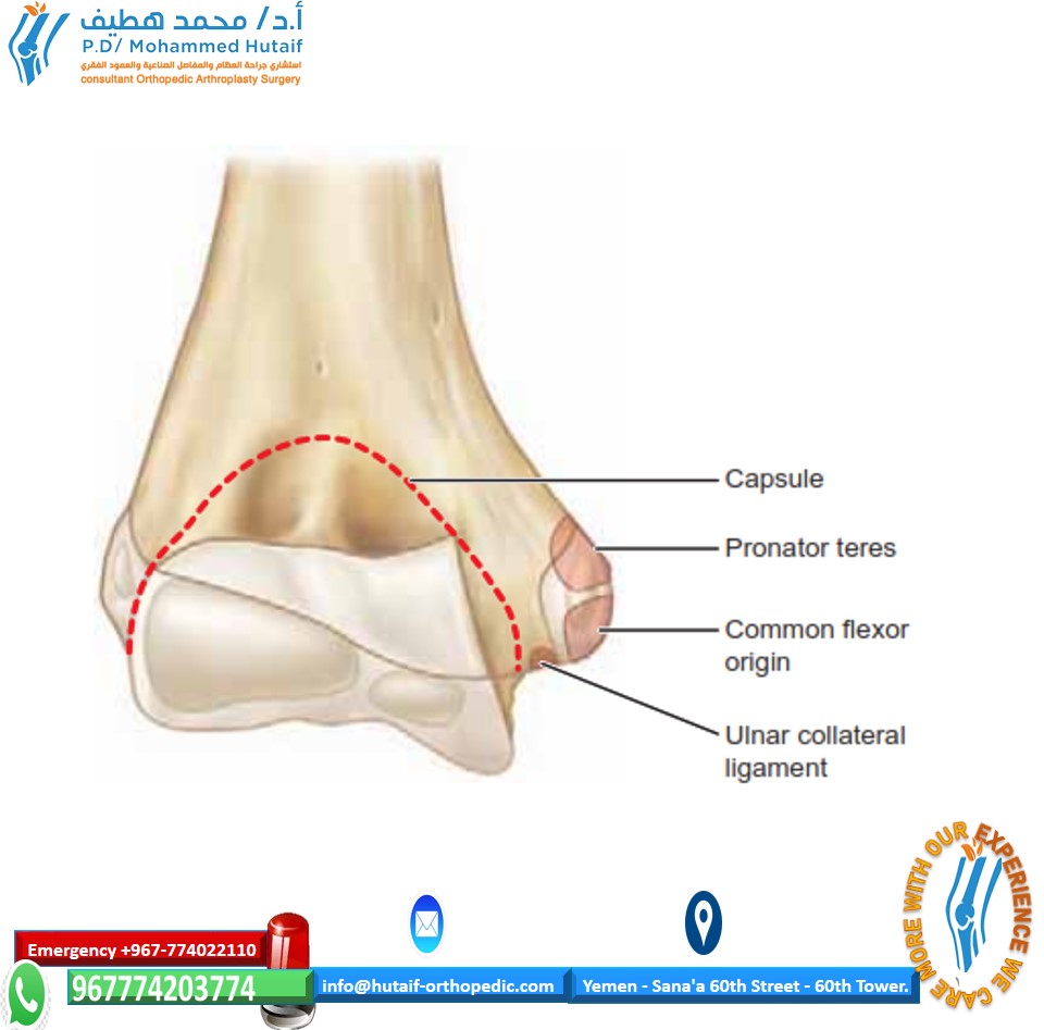 Medial Epi Condyle Fracture: Expert Guide to Healing & Stability