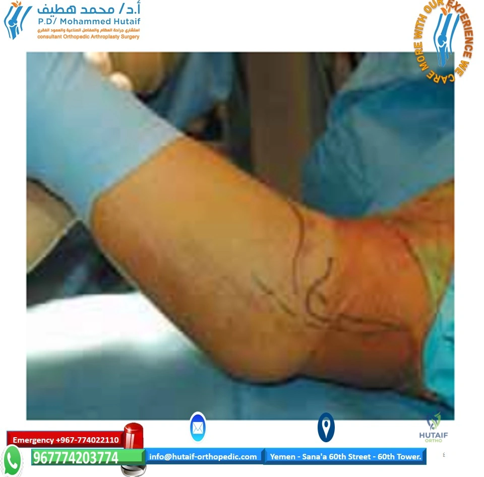 صورة توضيحية لـ كسور القدم والكاحل: دليل شامل للتشخيص والعلاج والتعافي مع الأستاذ الدكتور محمد هطيف