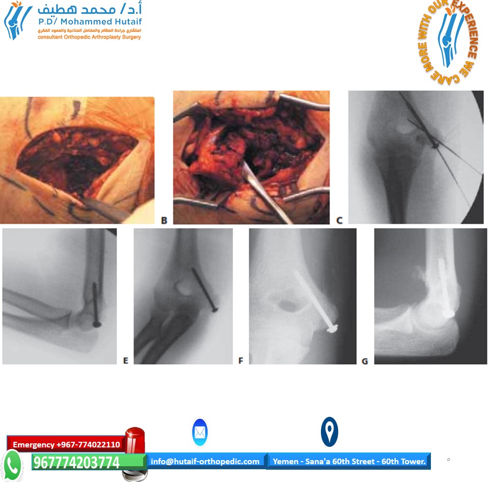 Illustration of medial epi condyle - Dr. Mohammed Hutaif