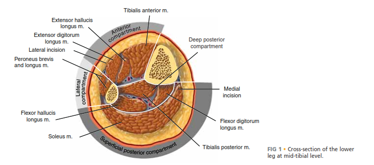 Acute Compartment Syndrome Fasciotomy: Urgent Surgical Guide